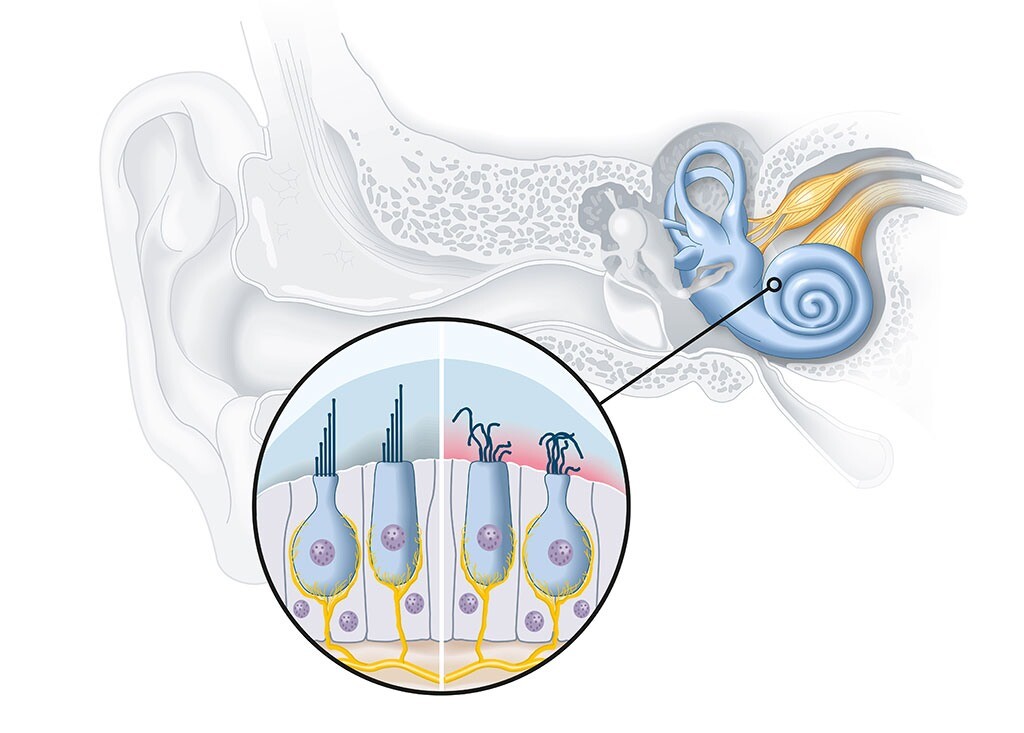 Gesunde-(links)-und-geschädigte-Haarzellen-im-Innenohr