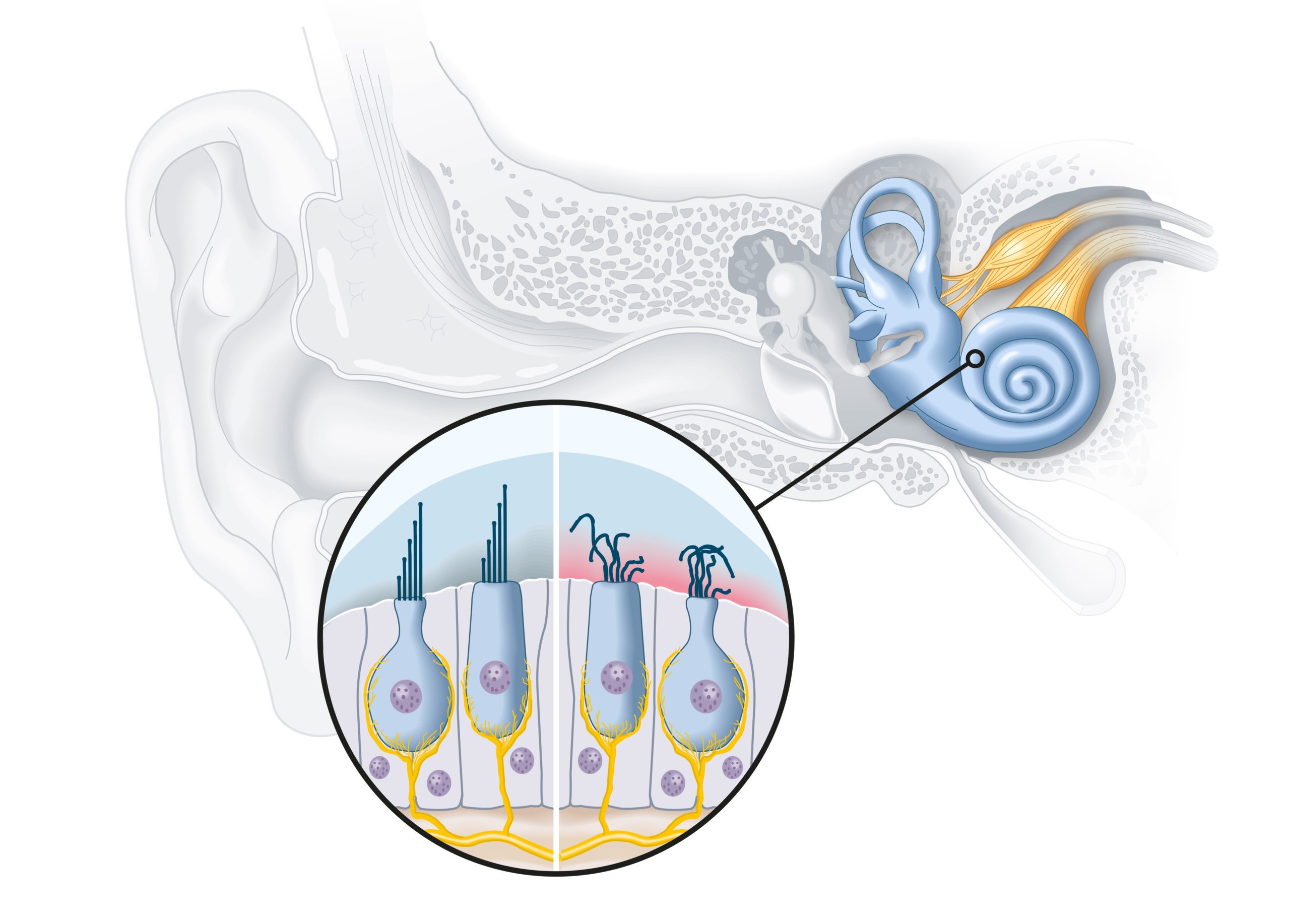 Tinnitus Beschädigte Haarzellen in Cochlea
