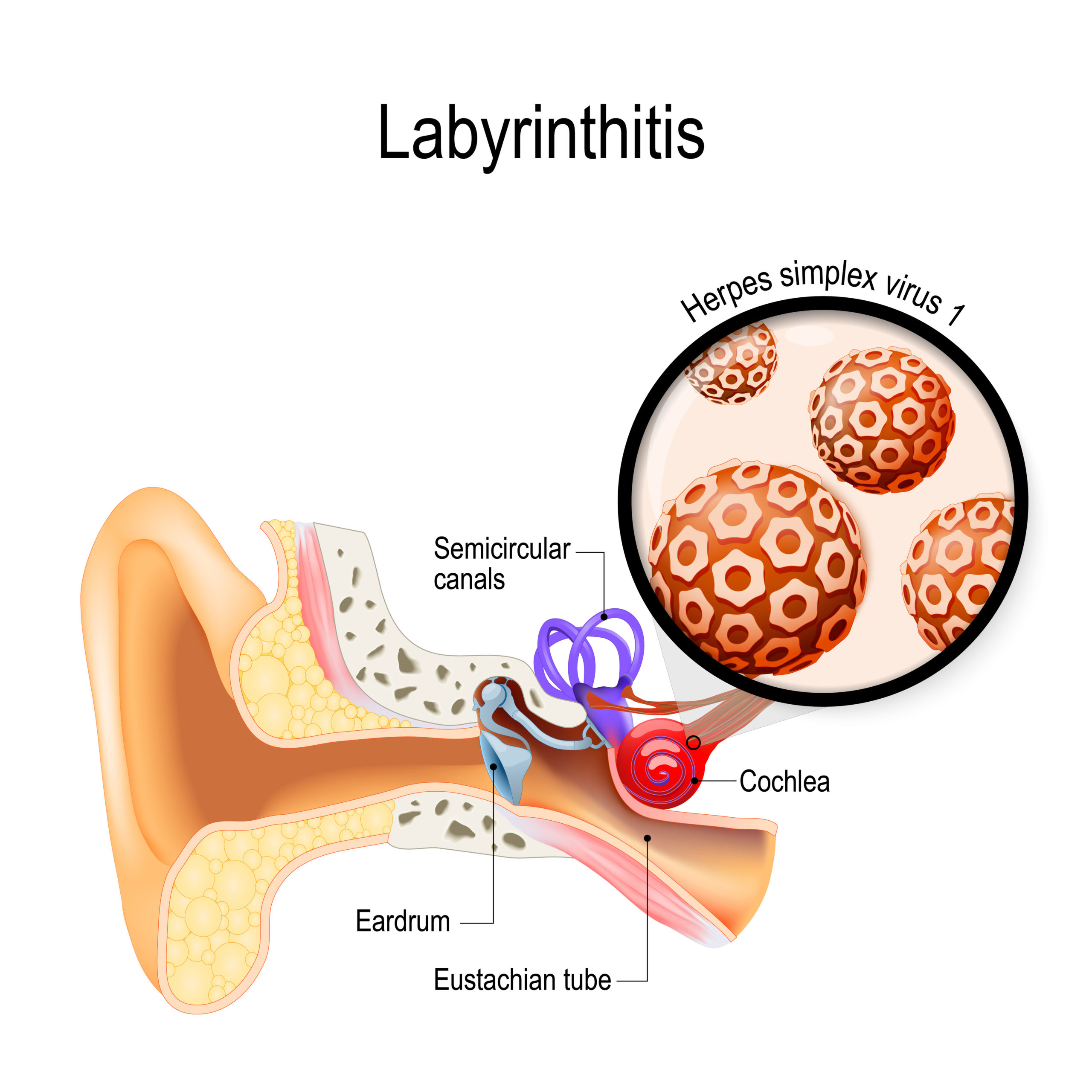 Medizinische Illustration des Ohrs mit Beschriftung zu Labyrinthitis und Herpes-simplex-Virus